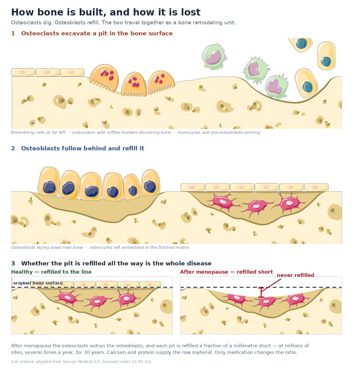 The Fracture Already Made the Diagnosis 1 How bone is built and lost: osteoclasts excavate a pit, osteoblasts refill it, and after menopause the pit is refilled short of the original surface.